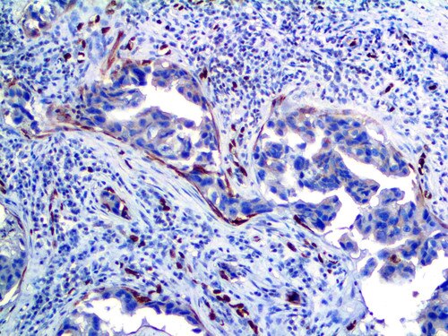 IHC of Cytokeratin 5, 6 & ERG on an FFPE Breast Tissue